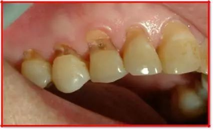 還在這樣刷牙嗎？當(dāng)心楔狀缺損找上門！